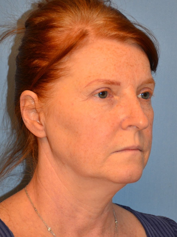 Facelift Before & After Gallery - Patient 233725 - Image 9