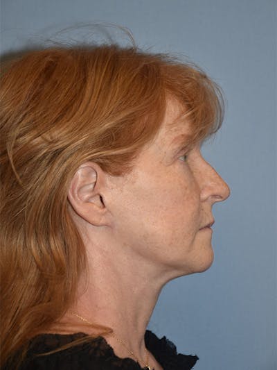 Facelift Before & After Gallery - Patient 233725 - Image 8