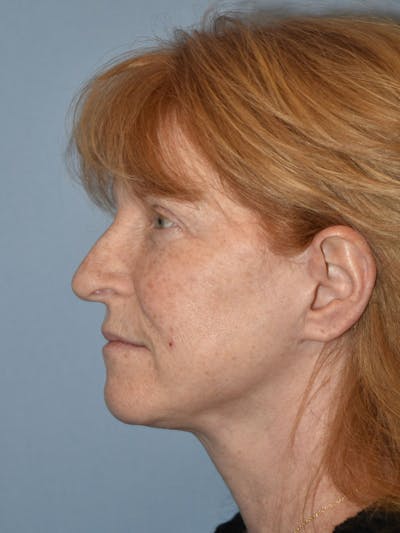 Facelift Before & After Gallery - Patient 233725 - Image 6