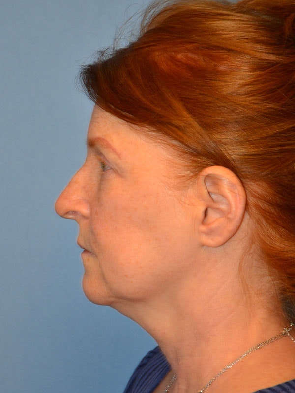 Facelift Before & After Gallery - Patient 233725 - Image 5