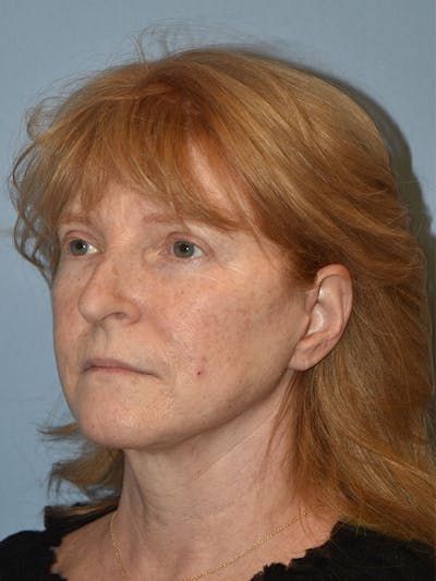 Facelift Before & After Gallery - Patient 233725 - Image 4