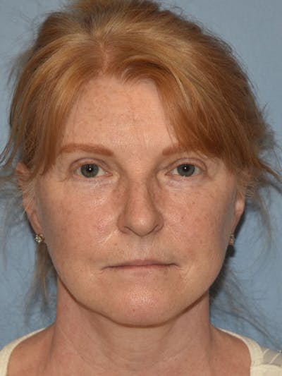 Facelift Before & After Gallery - Patient 233725 - Image 2