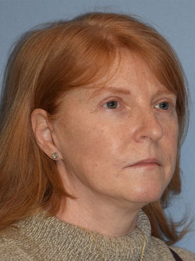 Facelift Before & After Gallery - Patient 233725 - Image 10