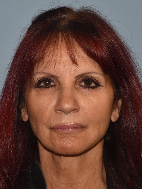 Facelift Before & After Gallery - Patient 212786 - Image 2
