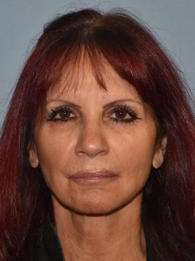 Facelift Before & After Gallery - Patient 212786 - Image 2