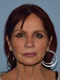 Facelift Before & After Gallery - Patient 212786 - Image 1