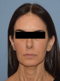 Facelift Before & After Gallery - Patient 230233 - Image 1