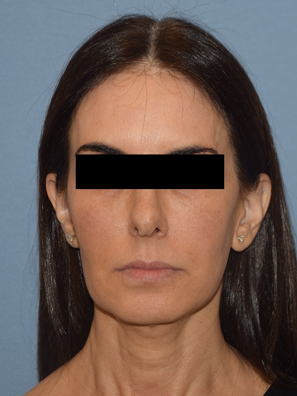 Facelift Before & After Gallery - Patient 230233 - Image 1