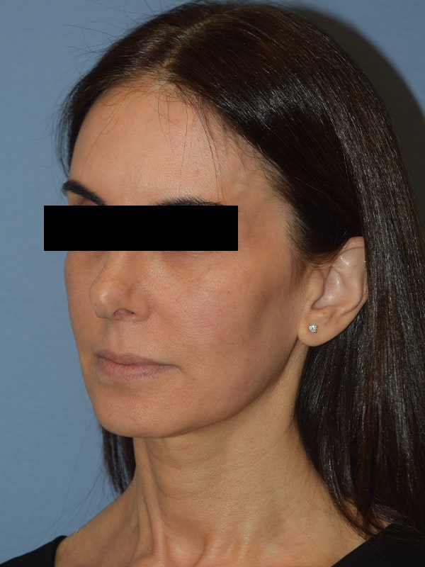 Facelift Before & After Gallery - Patient 230233 - Image 3