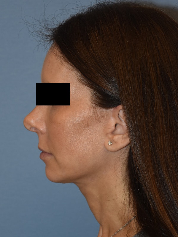 Facelift Before & After Gallery - Patient 230233 - Image 6