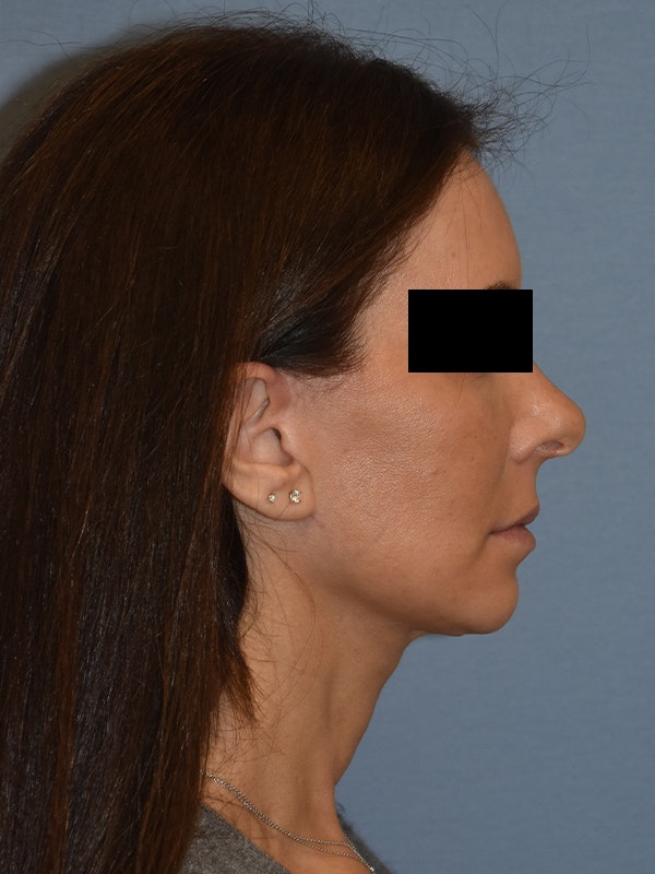 Facelift Before & After Gallery - Patient 230233 - Image 8