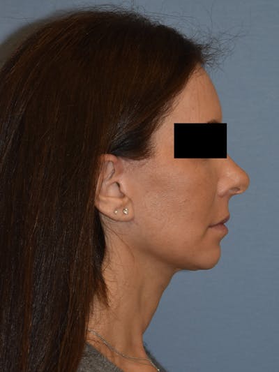 Facelift Before & After Gallery - Patient 230233 - Image 8
