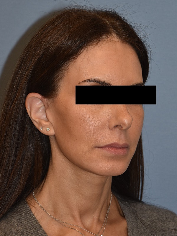 Facelift Before & After Gallery - Patient 230233 - Image 9