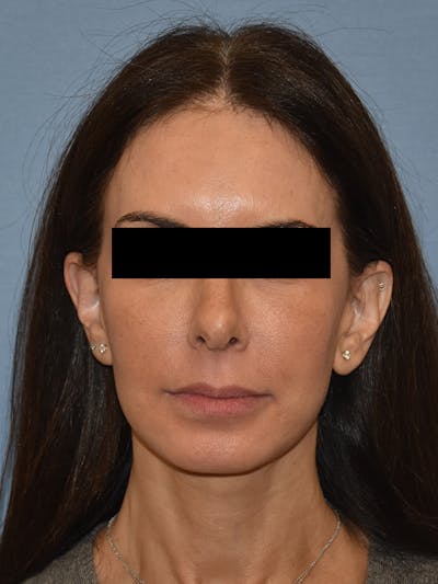 Facelift Before & After Gallery - Patient 230233 - Image 2