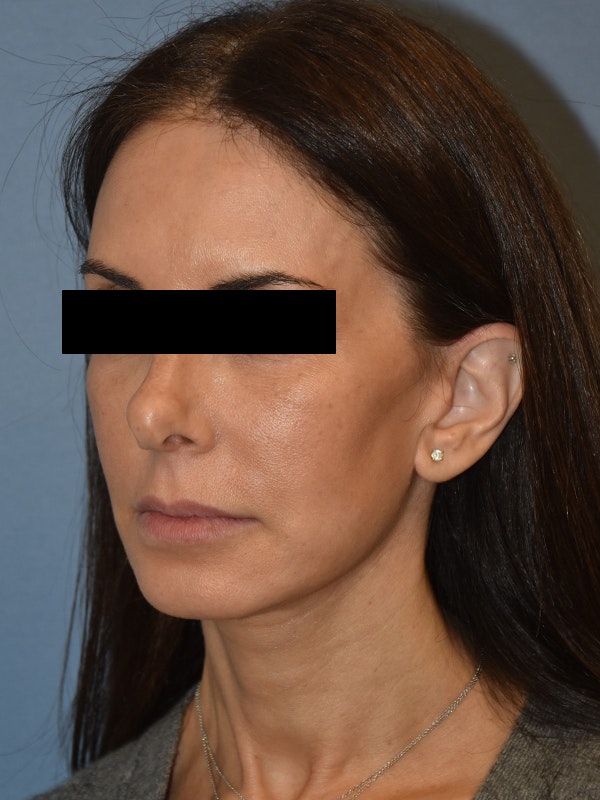 Facelift Before & After Gallery - Patient 230233 - Image 4