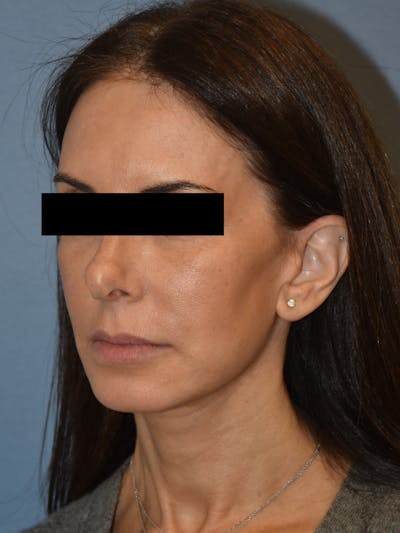 Facelift Before & After Gallery - Patient 230233 - Image 4