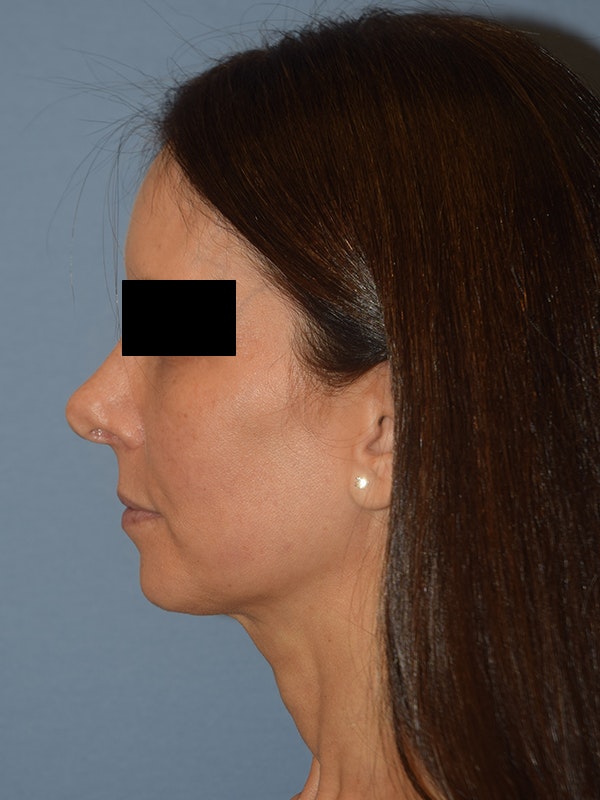 Facelift Before & After Gallery - Patient 230233 - Image 5