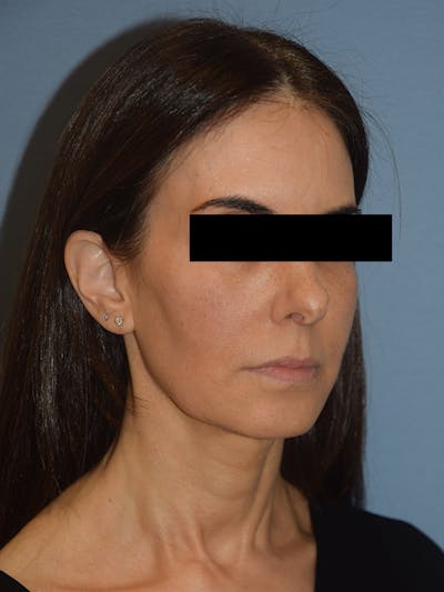 Facelift Before & After Gallery - Patient 230233 - Image 10