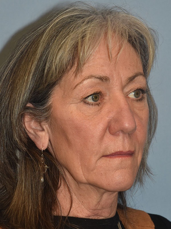 Facelift Before & After Gallery - Patient 930112 - Image 9