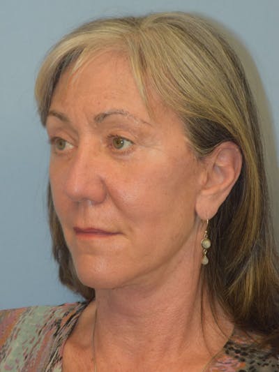 Facelift Before & After Gallery - Patient 930112 - Image 4
