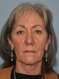 Facelift Before & After Gallery - Patient 930112 - Image 1