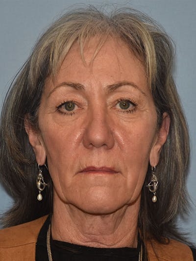 Facelift Before & After Gallery - Patient 930112 - Image 1