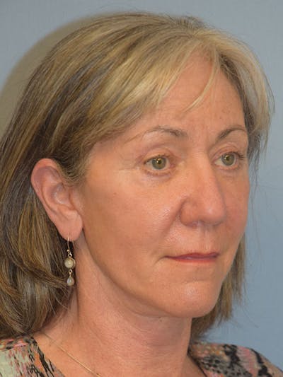 Facelift Before & After Gallery - Patient 930112 - Image 10