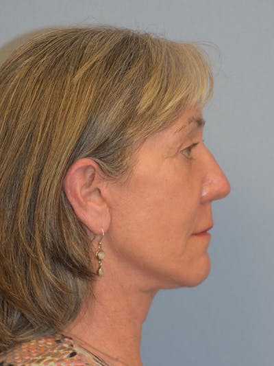 Facelift Before & After Gallery - Patient 930112 - Image 8
