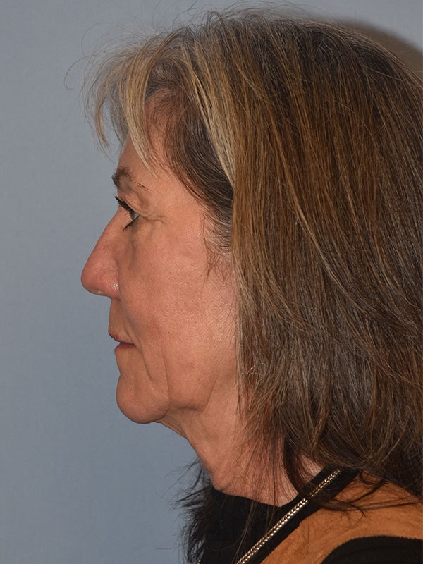 Facelift Before & After Gallery - Patient 930112 - Image 5