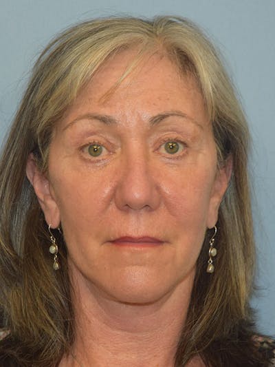 Facelift Before & After Gallery - Patient 930112 - Image 2
