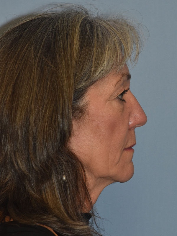 Facelift Before & After Gallery - Patient 930112 - Image 7