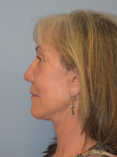 Facelift Before & After Gallery - Patient 930112 - Image 6