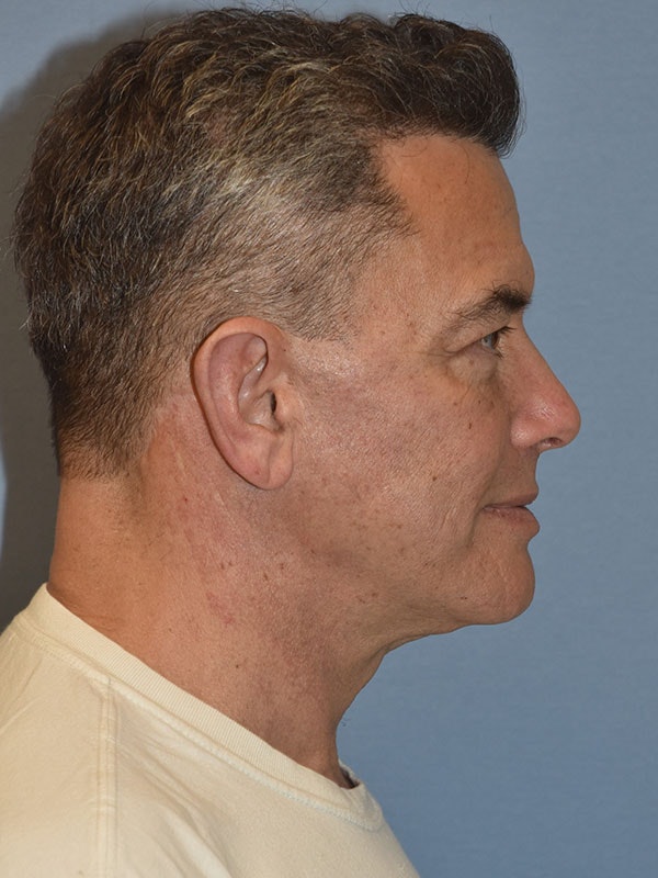 Facelift Before & After Gallery - Patient 129344 - Image 6