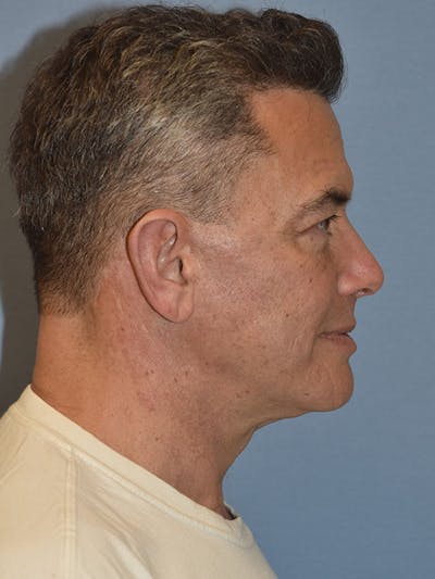 Facelift Before & After Gallery - Patient 129344 - Image 6