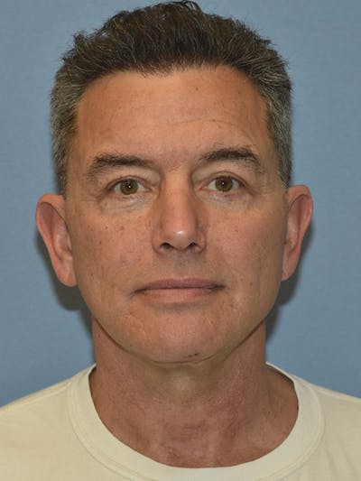 Facelift Before & After Gallery - Patient 129344 - Image 2