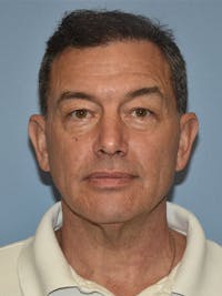 Facelift Before & After Gallery - Patient 129344 - Image 1