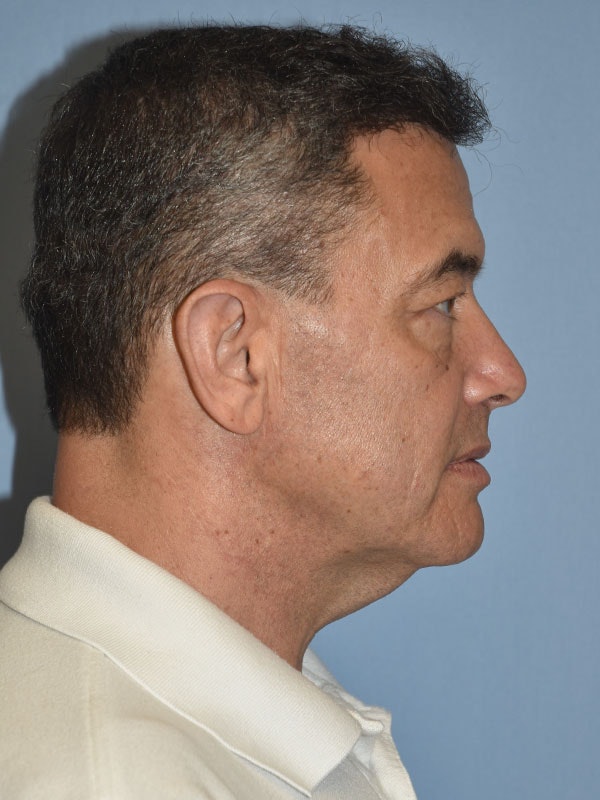 Facelift Before & After Gallery - Patient 129344 - Image 5