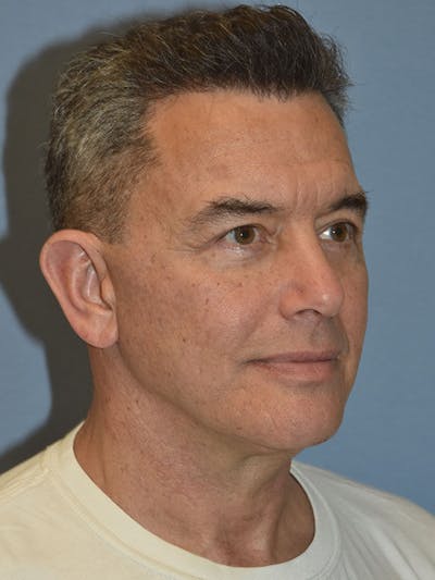 Facelift Before & After Gallery - Patient 129344 - Image 4