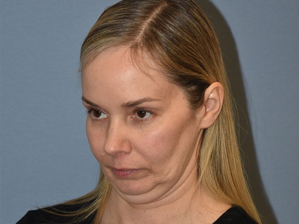 Facelift Before & After Gallery - Patient 341396 - Image 11