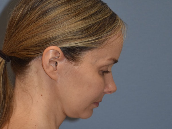Facelift Before & After Gallery - Patient 341396 - Image 8