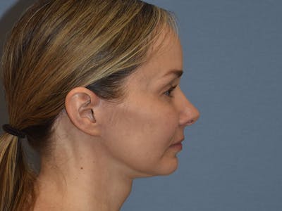 Facelift Before & After Gallery - Patient 341396 - Image 6