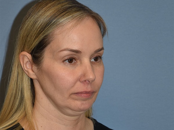 Facelift Before & After Gallery - Patient 341396 - Image 3