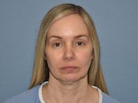 Facelift Before & After Gallery - Patient 341396 - Image 1