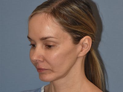 Facelift Before & After Gallery - Patient 341396 - Image 12
