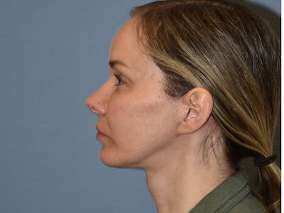 Facelift Before & After Gallery - Patient 341396 - Image 10