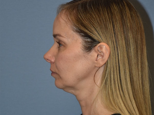 Facelift Before & After Gallery - Patient 341396 - Image 9