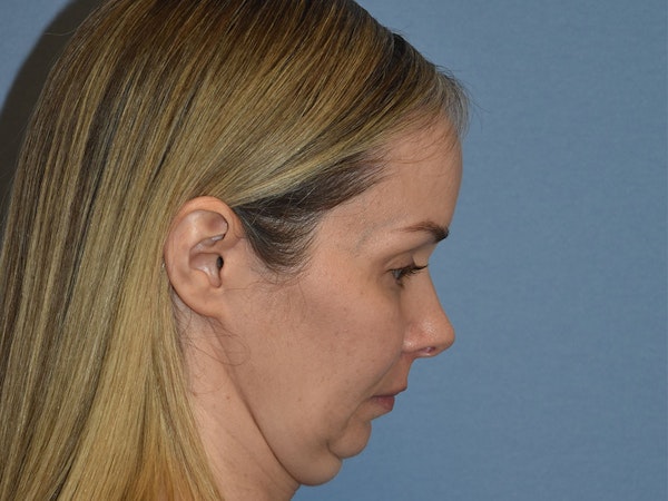 Facelift Before & After Gallery - Patient 341396 - Image 7