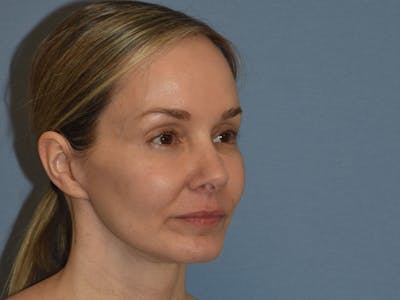 Facelift Before & After Gallery - Patient 341396 - Image 4