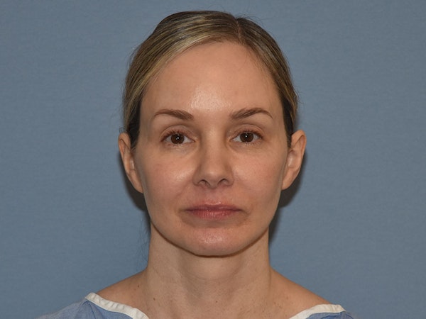 Facelift Before & After Gallery - Patient 341396 - Image 2