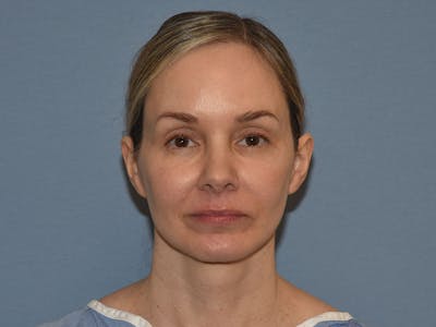 Facelift Before & After Gallery - Patient 341396 - Image 2